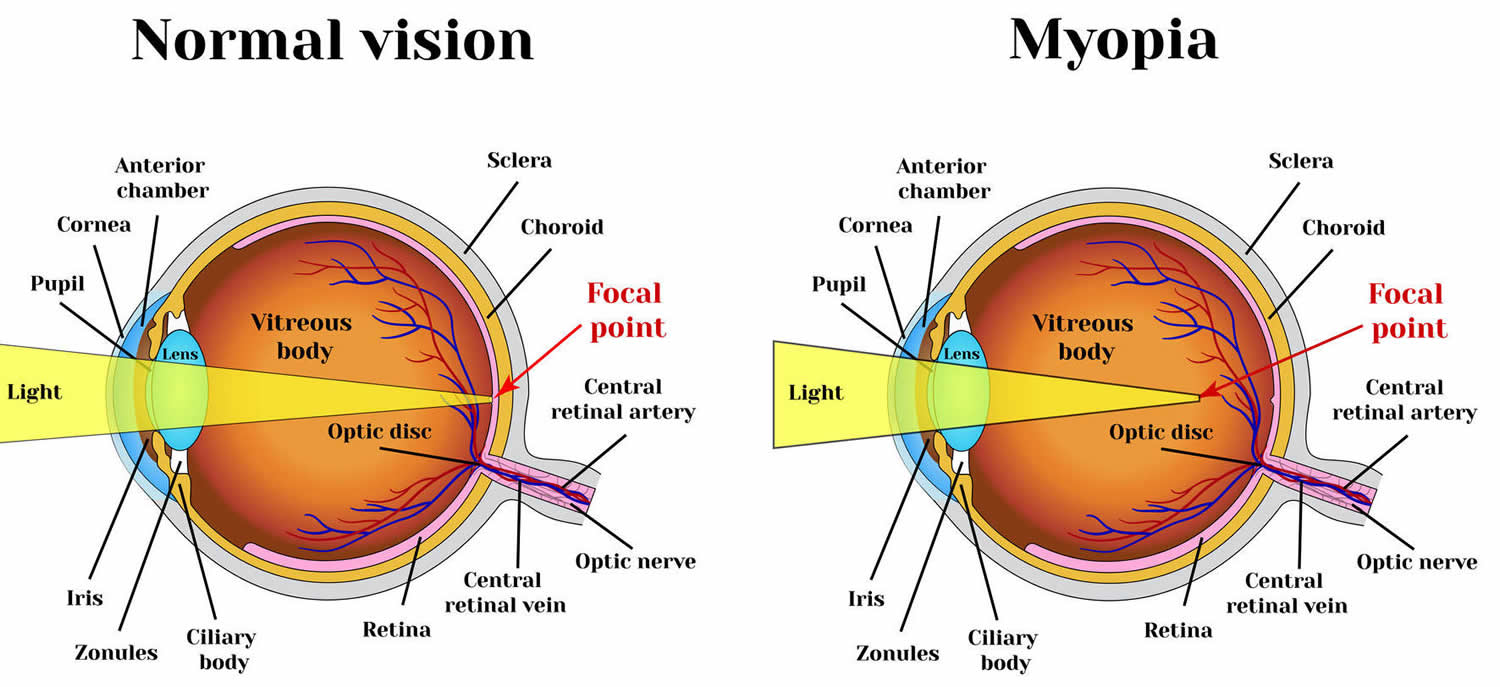 What Is Considered Moderate Nearsightedness