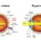 HYPEROPIA OR FARSIGHTEDNESS