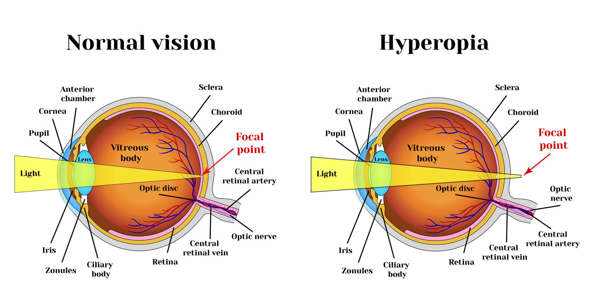 hyperopia-or-farsightedness-heritage-optical