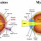 MYOPIA OR NEARSIGHTEDNESS